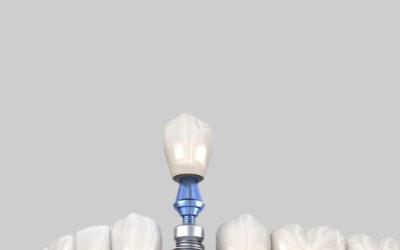 Perimplantite: cos’è e come l’igiene professionale protegge il tuo impianto nel tempo