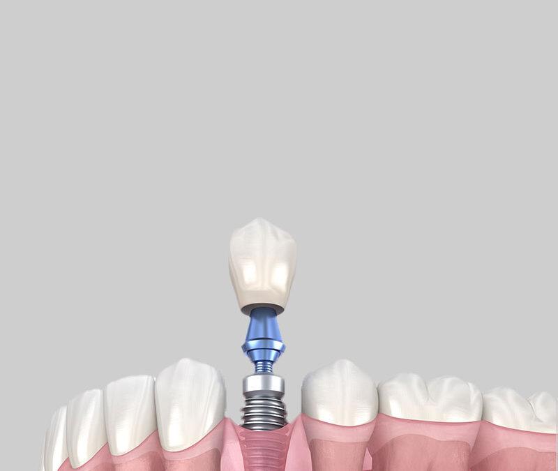 Perimplantite: cos’è e come l’igiene professionale protegge il tuo impianto nel tempo